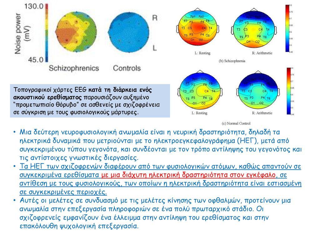 Τοπογραφικοί χάρτες EEG κατά τη διάρκεια ενός ακουστικού ερεθίσματος παρουσιάζουν αυξημένο προμετωπιαίο θόρυβο σε ασθενείς με σχιζοφρένεια σε σύγκριση με τους φυσιολογικούς μάρτυρες.