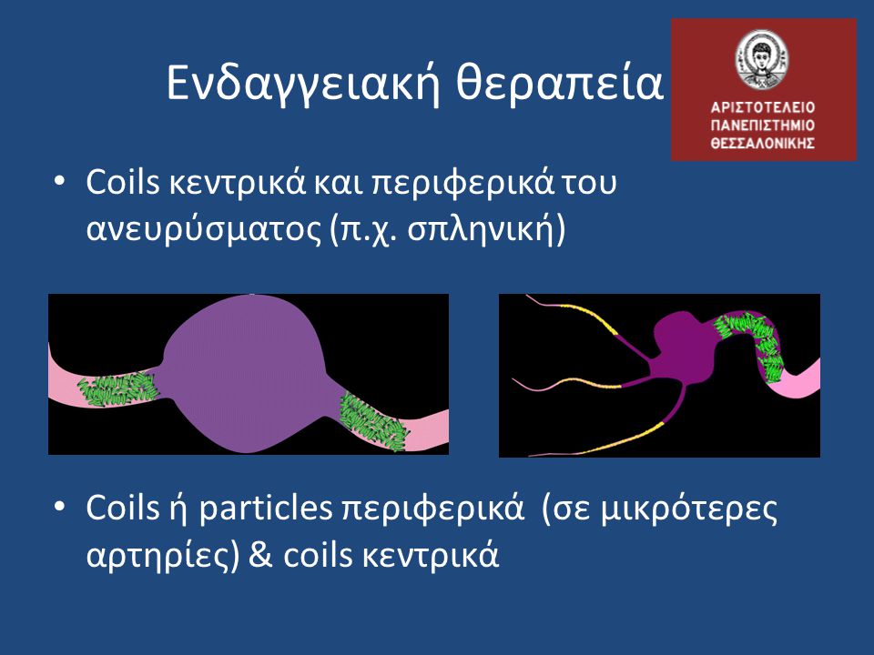Ενδαγγειακή θεραπεία Coils κεντρικά και περιφερικά του ανευρύσματος (π.χ. σπληνική)