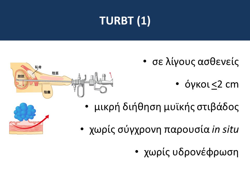 TURBT (1) σε λίγους ασθενείς όγκοι <2 cm