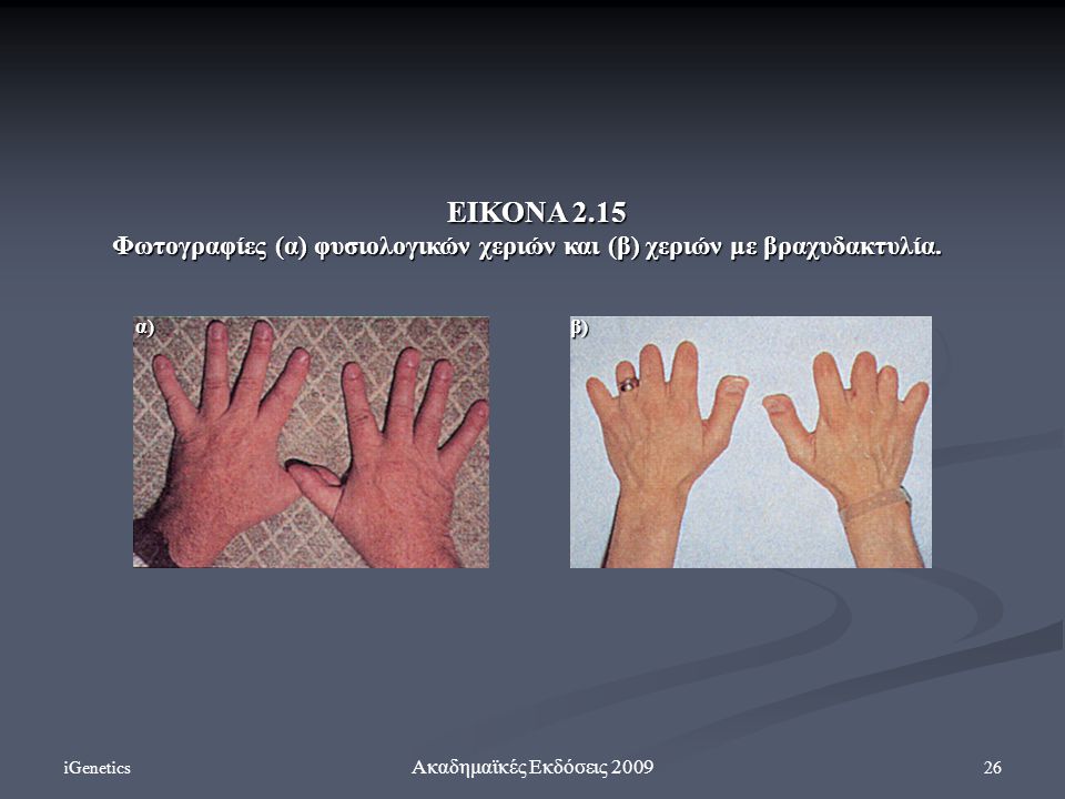 ΕΙΚΟΝΑ 2.15 Φωτογραφίες (α) φυσιολογικών χεριών και (β) χεριών με βραχυδακτυλία. α) β) iGenetics.
