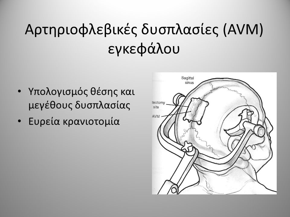 Αρτηριοφλεβικές δυσπλασίες (AVM) εγκεφάλου