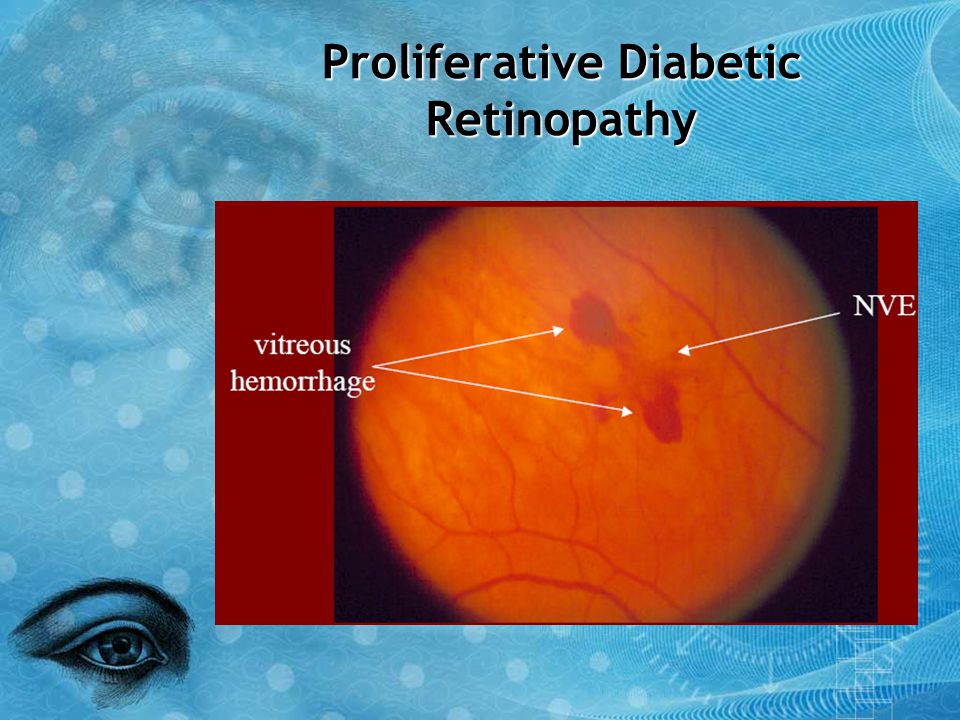 Proliferative Diabetic Retinopathy