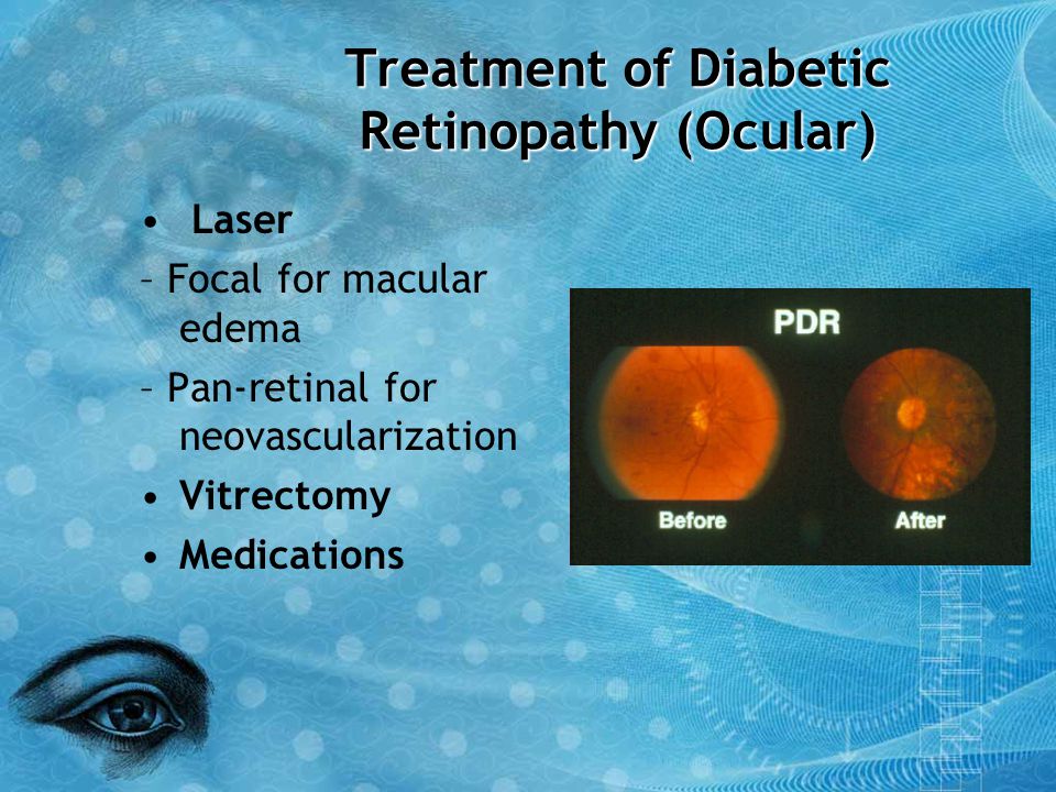 Treatment of Diabetic Retinopathy (Ocular)