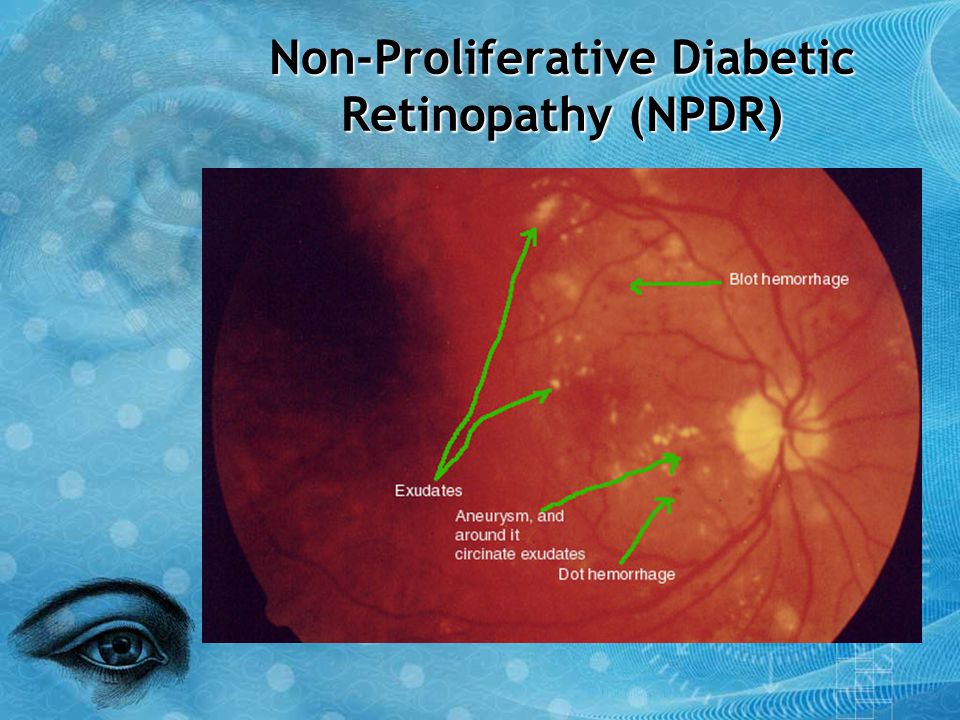 Non-Proliferative Diabetic Retinopathy (NPDR)