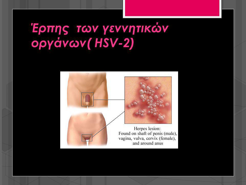 Έρπης των γεννητικών οργάνων( HSV-2)