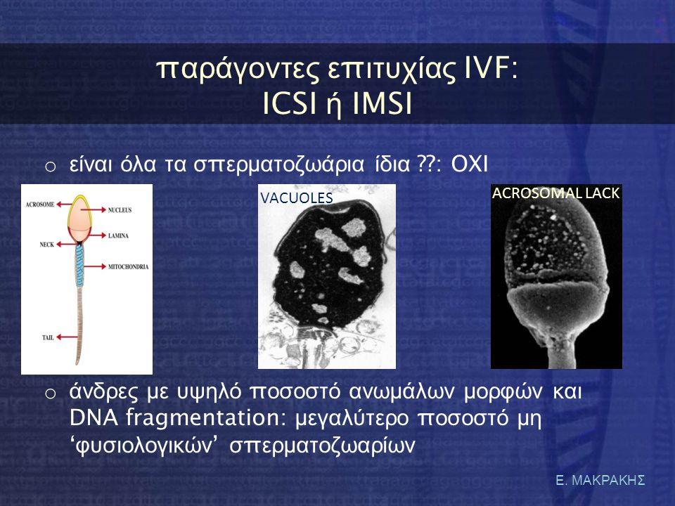 παράγοντες επιτυχίας IVF: ICSI ή IMSI