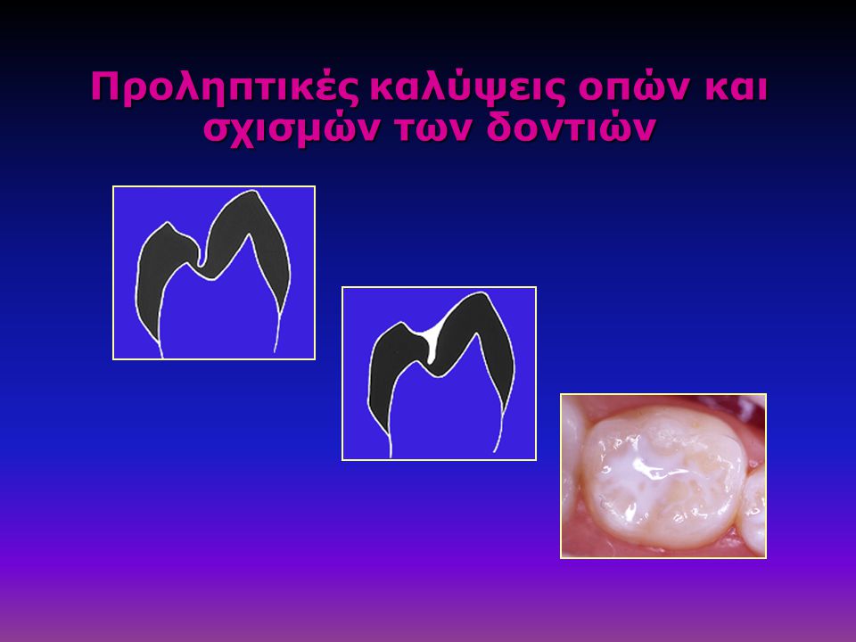 Προληπτικές καλύψεις οπών και σχισμών των δοντιών