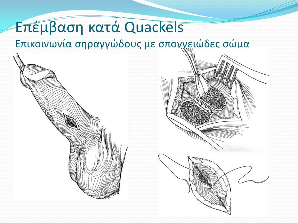 Επέμβαση κατά Quackels Επικοινωνία σηραγγώδους με σπογγειώδες σώμα