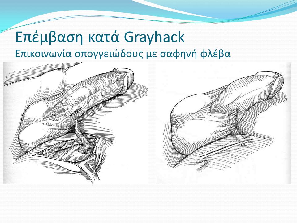 Επέμβαση κατά Grayhack Επικοινωνία σπογγειώδους με σαφηνή φλέβα