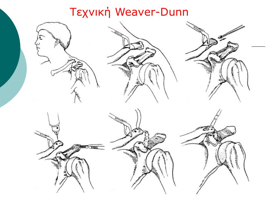 Τεχνική Weaver-Dunn