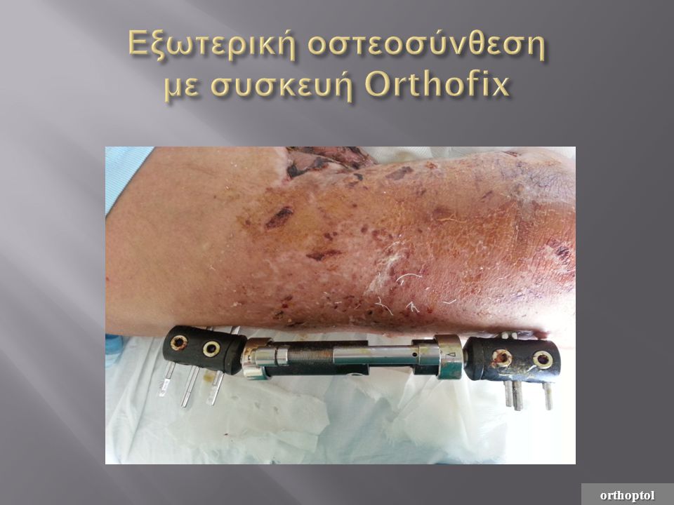 Εξωτερική οστεοσύνθεση με συσκευή Orthofix