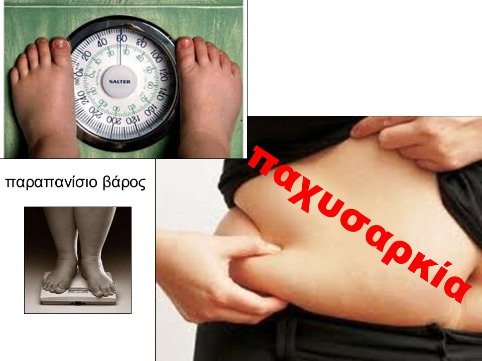 παραπανίσιο βάρος παχυσαρκία