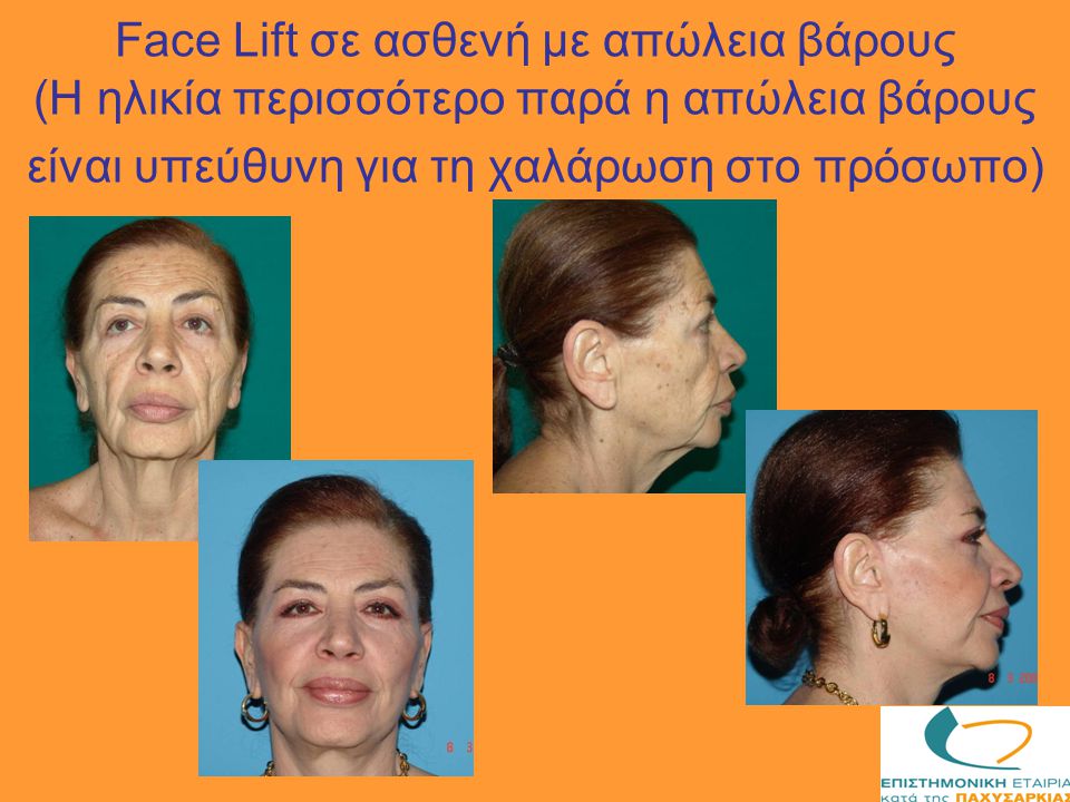 Face Lift σε ασθενή με απώλεια βάρους (Η ηλικία περισσότερο παρά η απώλεια βάρους είναι υπεύθυνη για τη χαλάρωση στο πρόσωπο)