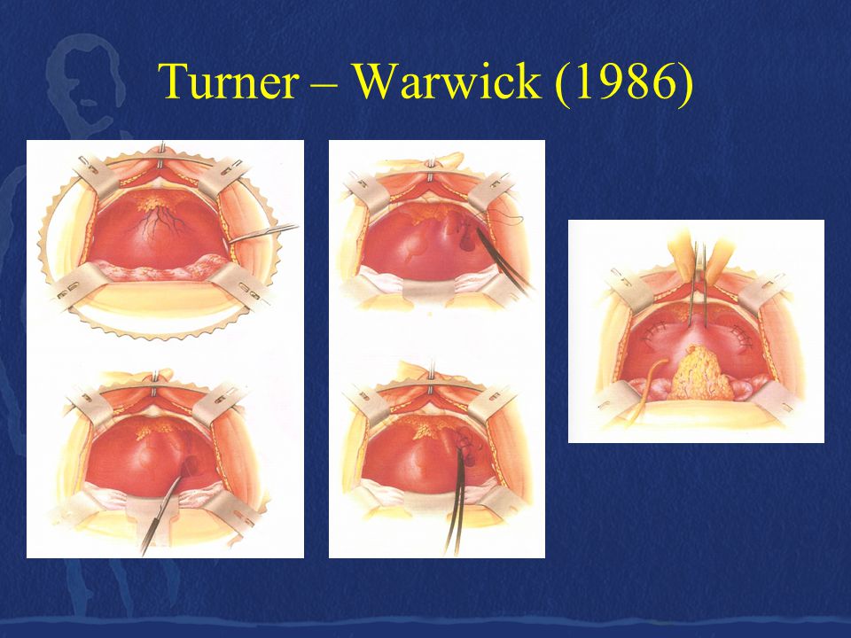 Turner – Warwick (1986)