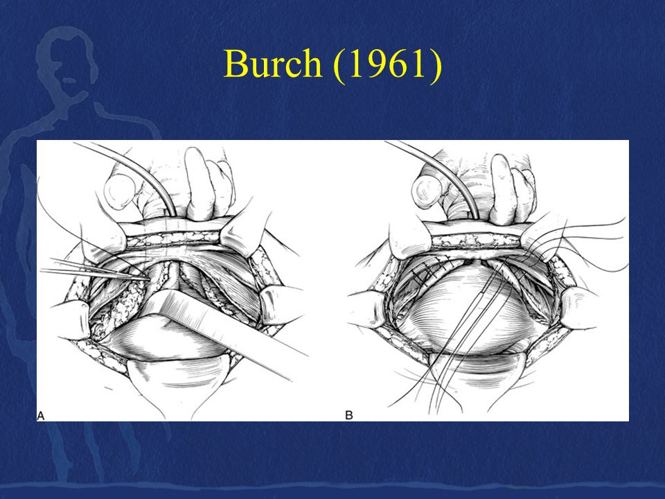Burch (1961)