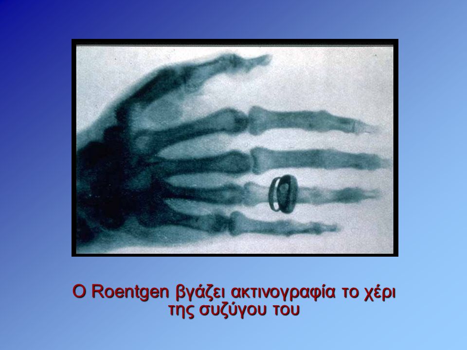 O Roentgen βγάζει ακτινογραφία το χέρι της συζύγου του