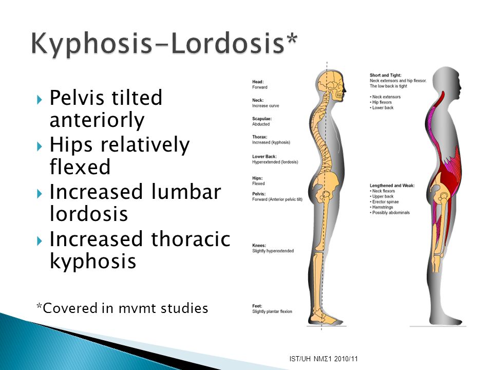 Kyphosis-Lordosis* Pelvis tilted anteriorly Hips relatively flexed