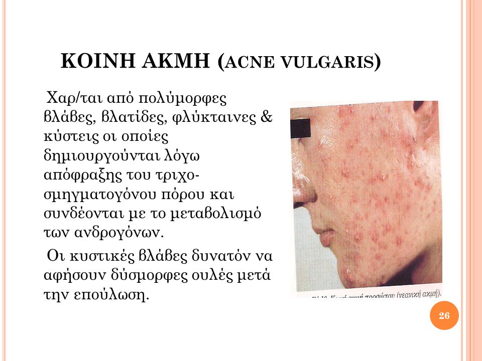 ΚΟΙΝΗ ΑΚΜΗ (acne vulgaris)