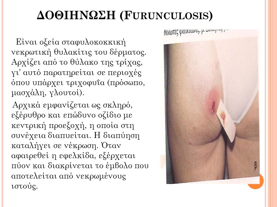 ΔΟΘΙΗΝΩΣΗ (Furunculosis)