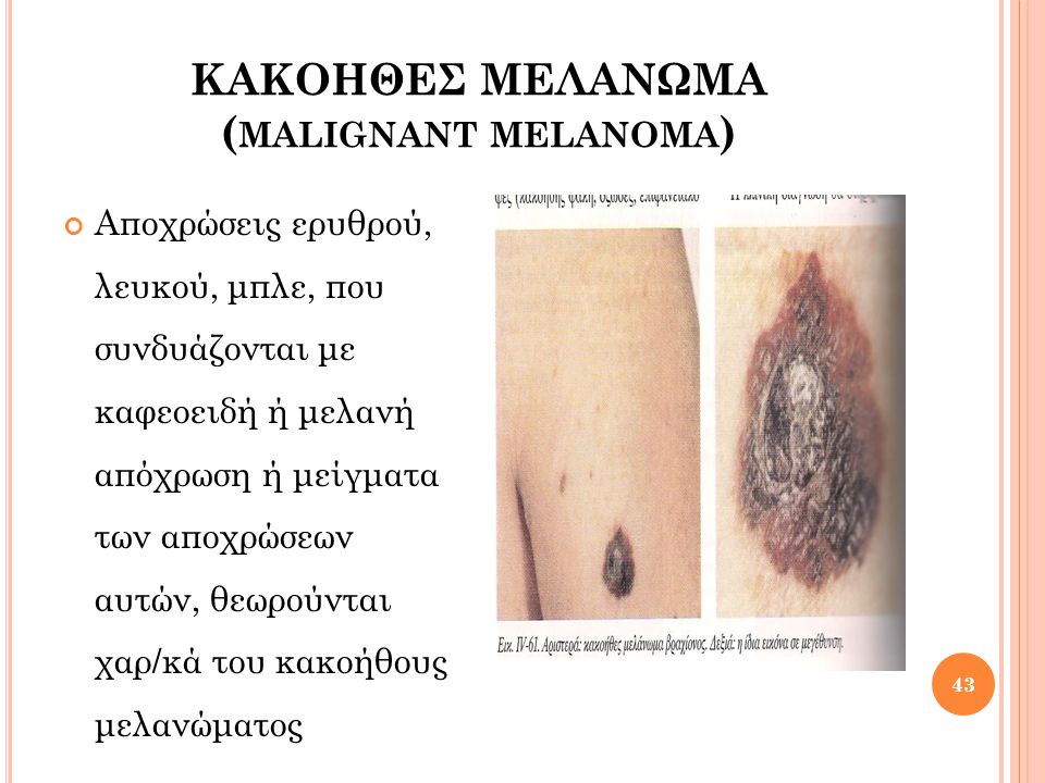 ΚΑΚΟΗΘΕΣ ΜΕΛΑΝΩΜΑ (malignant melanoma)