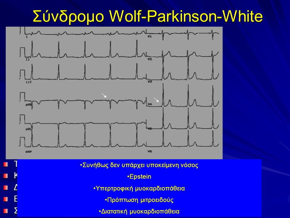 Σύνδρομο Wolf-Parkinson-White