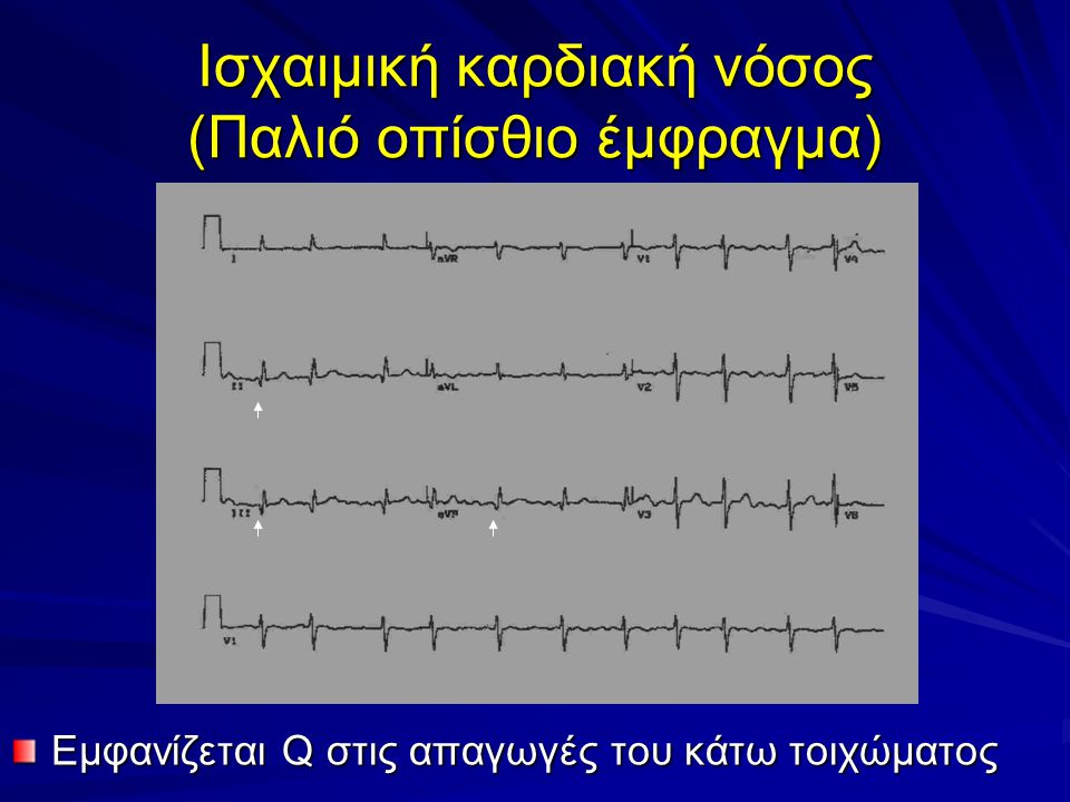 Ισχαιμική καρδιακή νόσος (Παλιό οπίσθιο έμφραγμα)