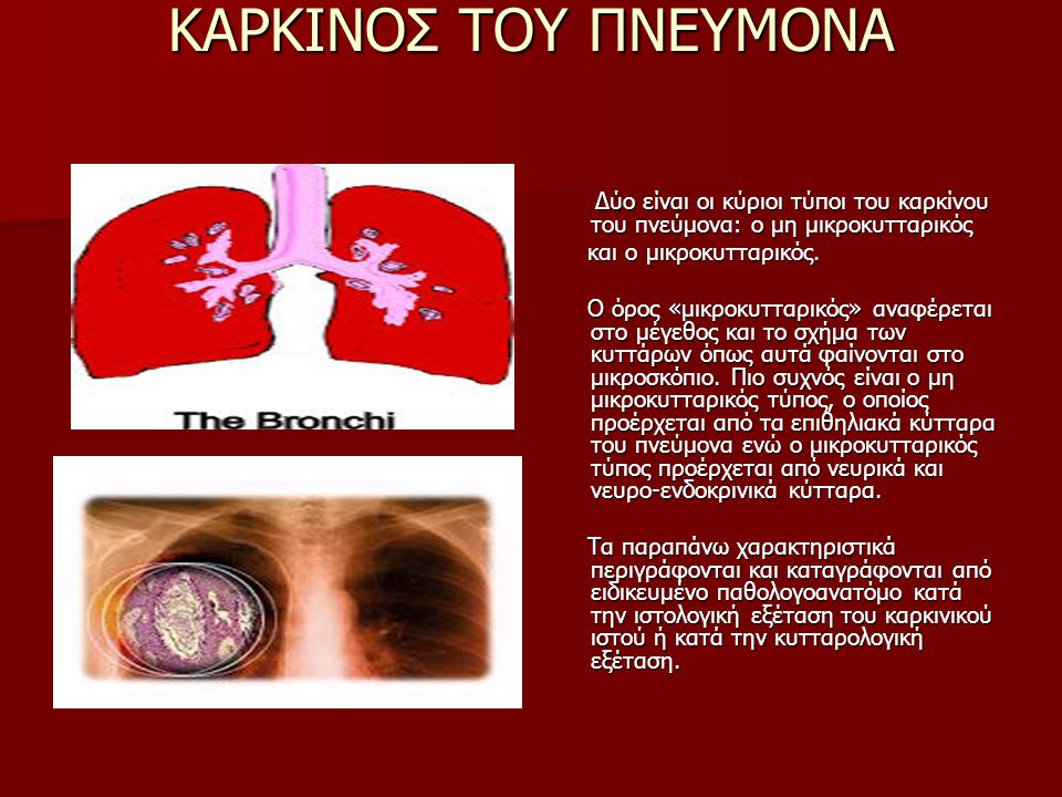 ΚΑΡΚΙΝΟΣ ΤΟΥ ΠΝΕΥΜΟΝΑ Δύο είναι οι κύριοι τύποι του καρκίνου του πνεύμονα: ο μη μικροκυτταρικός. και ο μικροκυτταρικός.