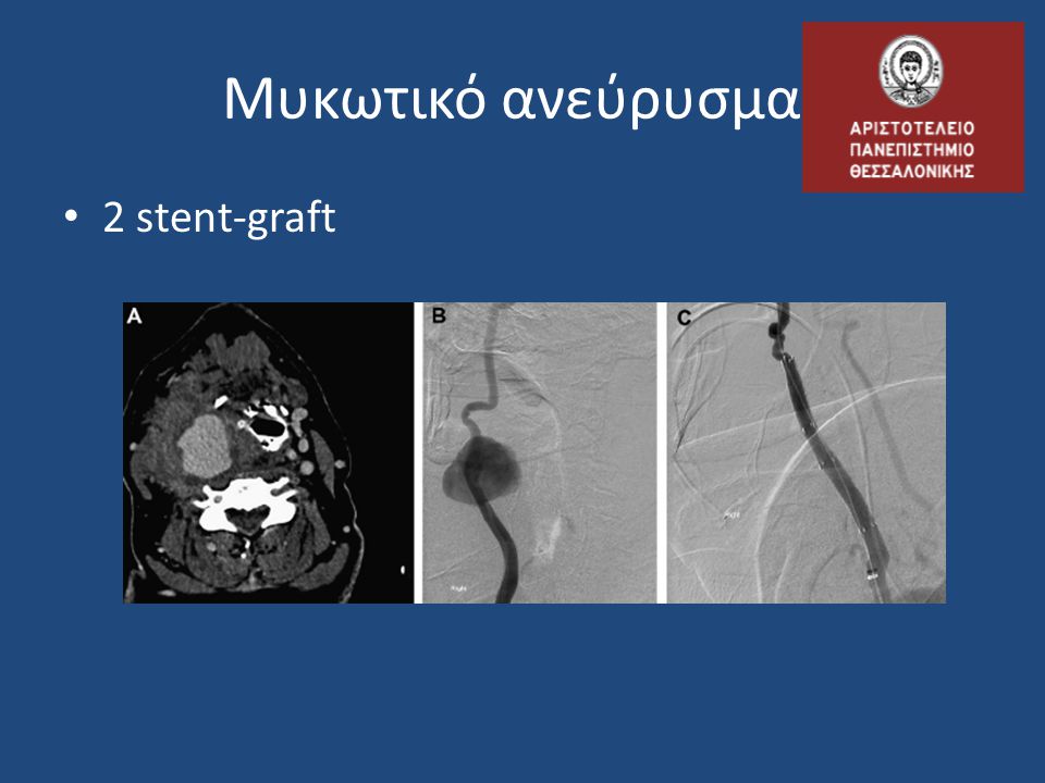 Μυκωτικό ανεύρυσμα 2 stent-graft