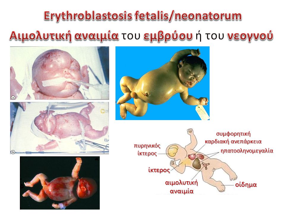 Erythroblastosis fetalis/neonatorum