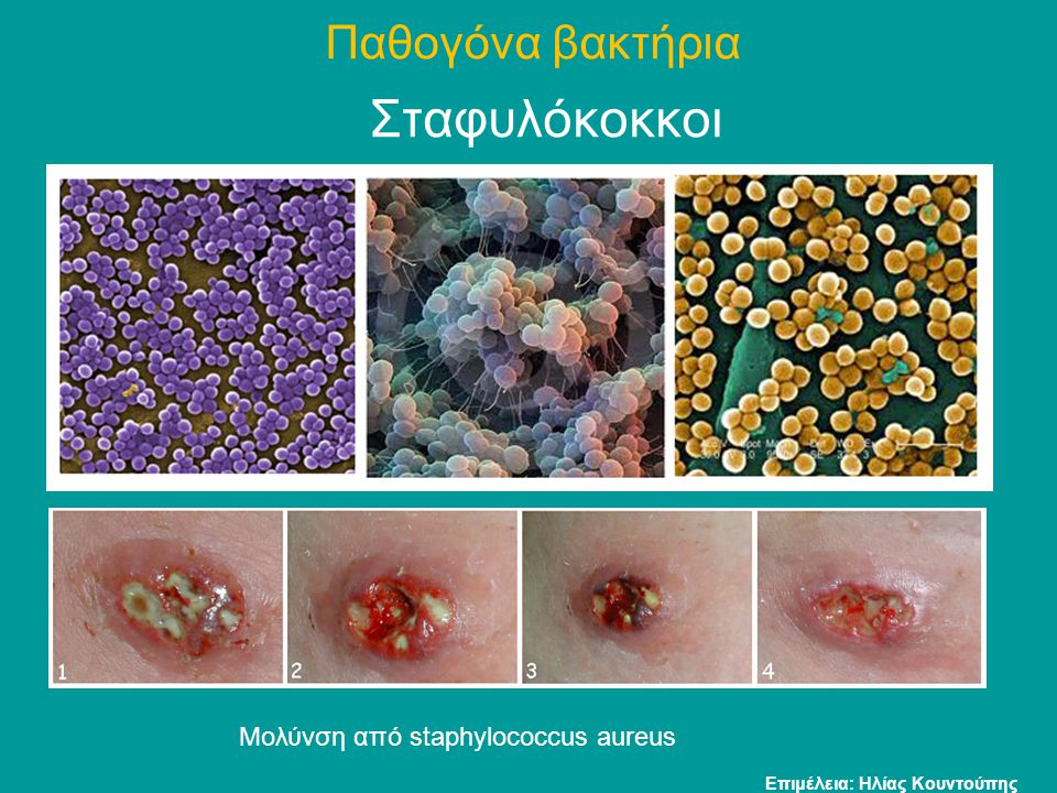 Σταφυλόκοκκοι Παθογόνα βακτήρια Μολύνση από staphylococcus aureus