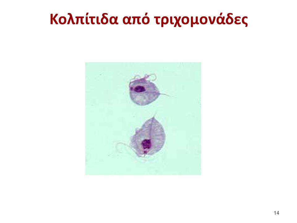 Βακτηριακή κολπίτιδα Κριτήρια βακτηριακής κολπίτιδας : pH > 5,