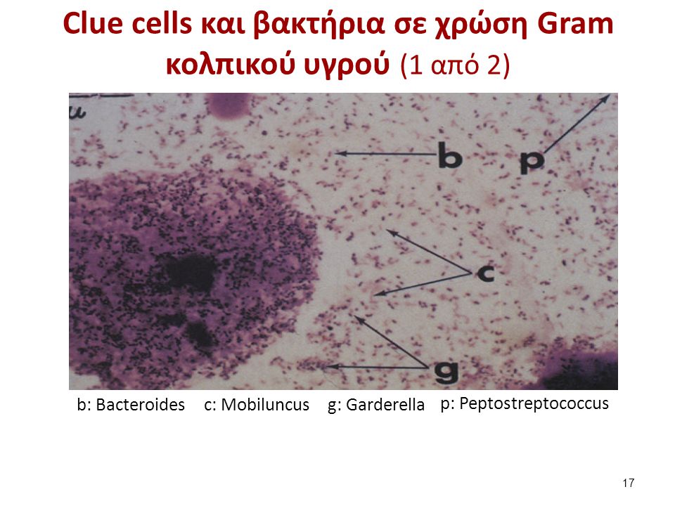 Clue cells και βακτήρια σε χρώση Gram κολπικού υγρού (2 από 2)