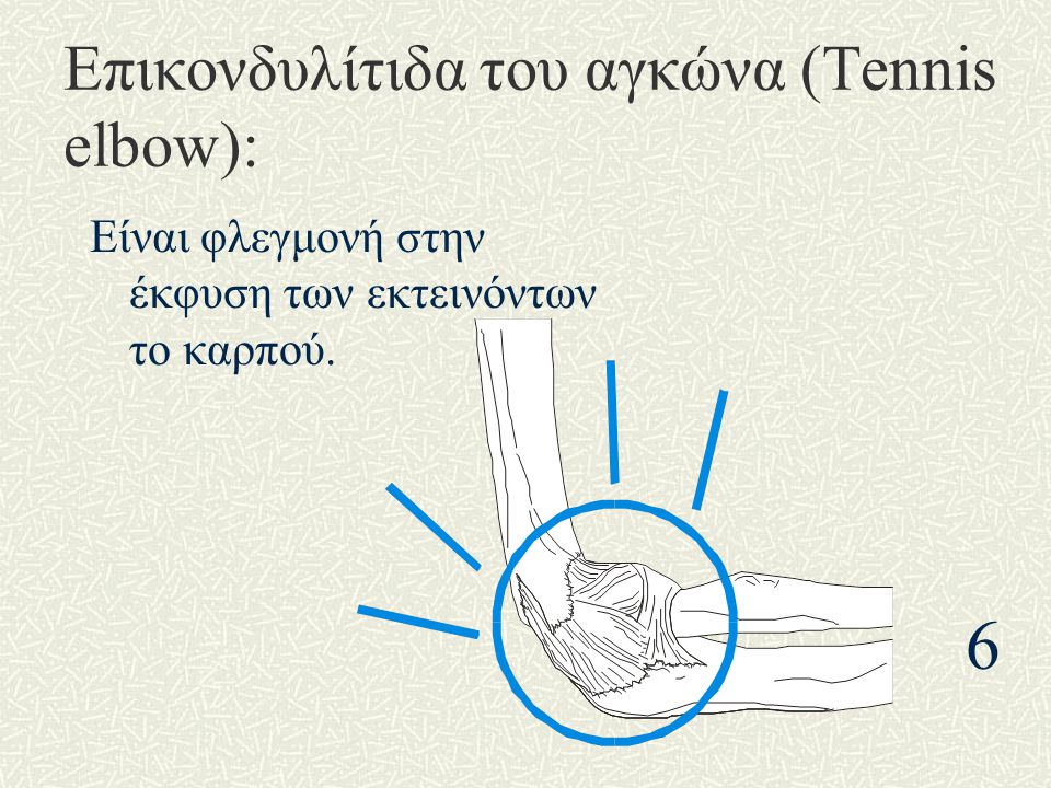 Επικονδυλίτιδα του αγκώνα (Tennis elbow):