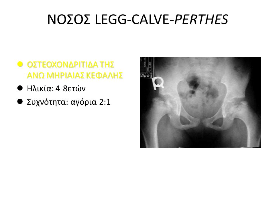ΝΟΣΟΣ LEGG-CALVE-PERTHES