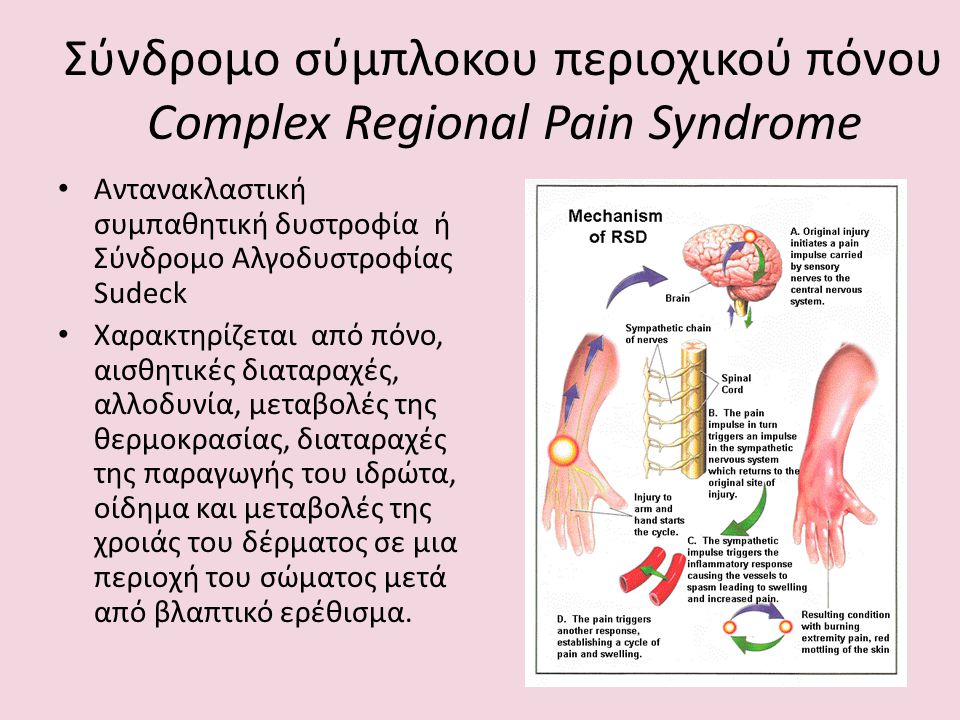 Σύνδρομο σύμπλοκου περιοχικού πόνου Complex Regional Pain Syndrome