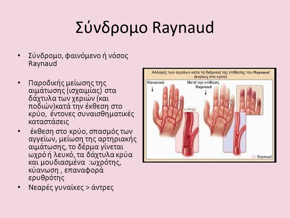 Σύνδρομο Raynaud Σύνδρομο, φαινόμενο ή νόσος Raynaud