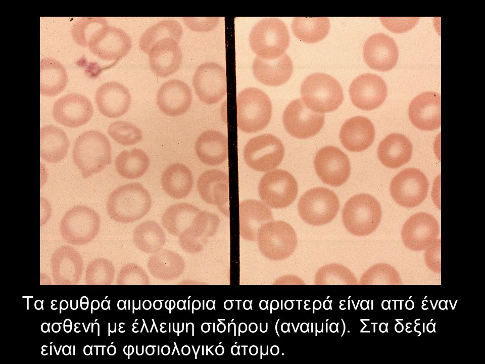 Τα ερυθρά αιμοσφαίρια στα αριστερά είναι από έναν ασθενή με έλλειψη σιδήρου (αναιμία).