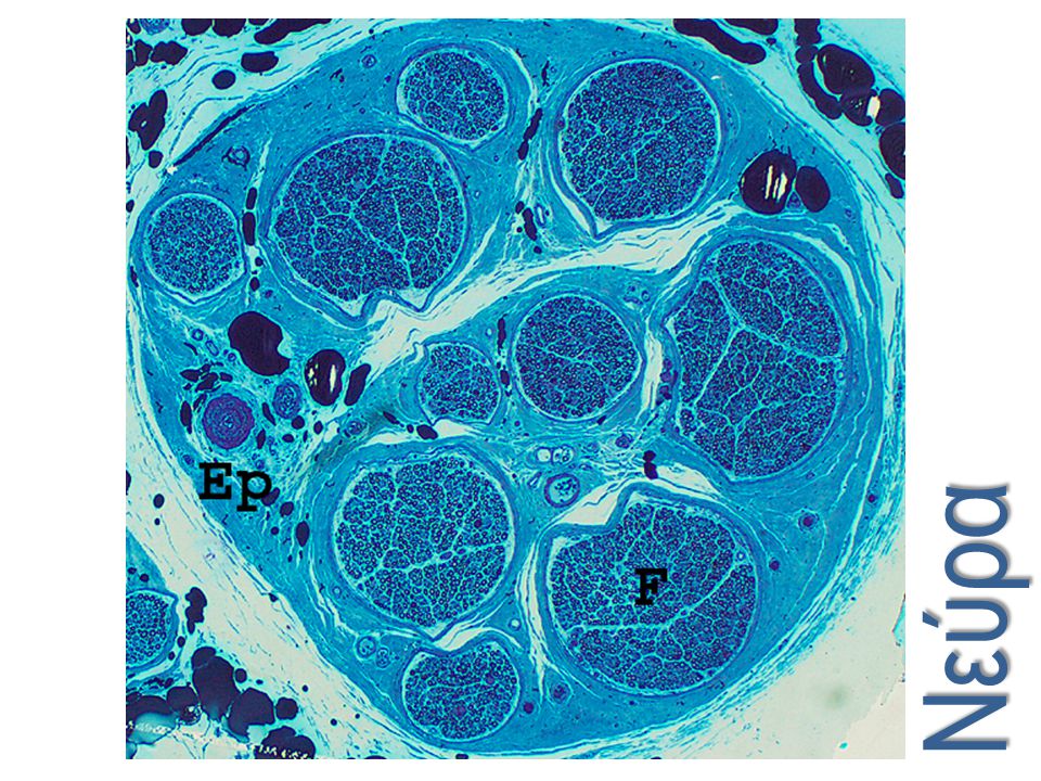 Normal sural nerve. This low power image shows a transverse section of essentially normal sural nerve embedded in plastic and stained with toluidine blue. Note the epineurium as it surrounds the nerve and blends with the adjacent connective tissue.Ep =epineurium; F = nerve fascicle. (Toluidine blue, 40x)
