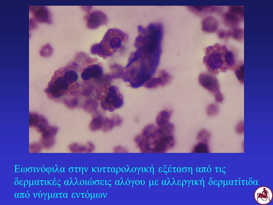 Εωσινόφιλα στην κυτταρολογική εξέταση από τις δερματικές αλλοιώσεις αλόγου με αλλεργική δερματίτιδα από νύγματα εντόμων