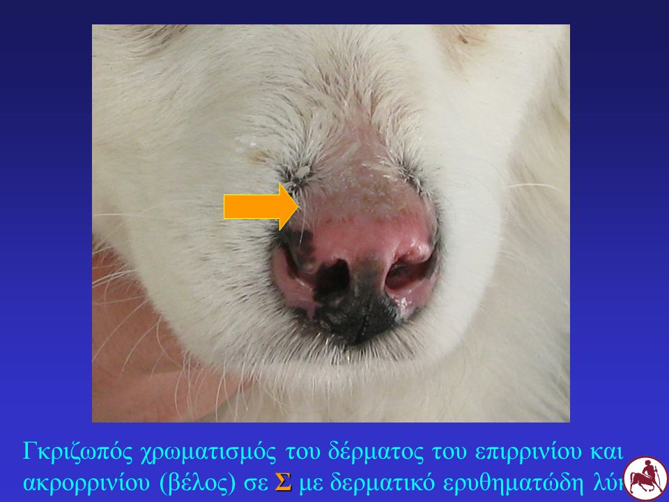 Γκριζωπός χρωματισμός του δέρματος του επιρρινίου και ακρορρινίου (βέλος) σε Σ με δερματικό ερυθηματώδη λύκο