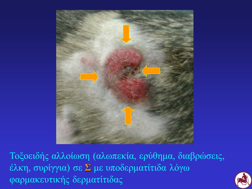 Τοξοειδής αλλοίωση (αλωπεκία, ερύθημα, διαβρώσεις, έλκη, συρίγγια) σε Σ με υποδερματίτιδα λόγω φαρμακευτικής δερματίτιδας