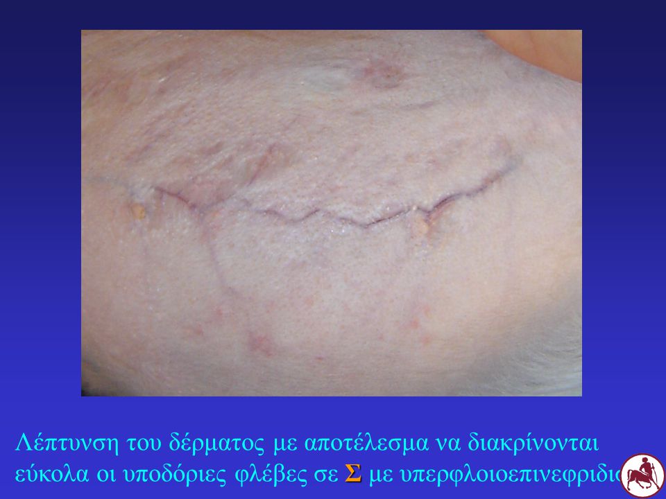 Λέπτυνση του δέρματος με αποτέλεσμα να διακρίνονται εύκολα οι υποδόριες φλέβες σε Σ με υπερφλοιοεπινεφριδισμό