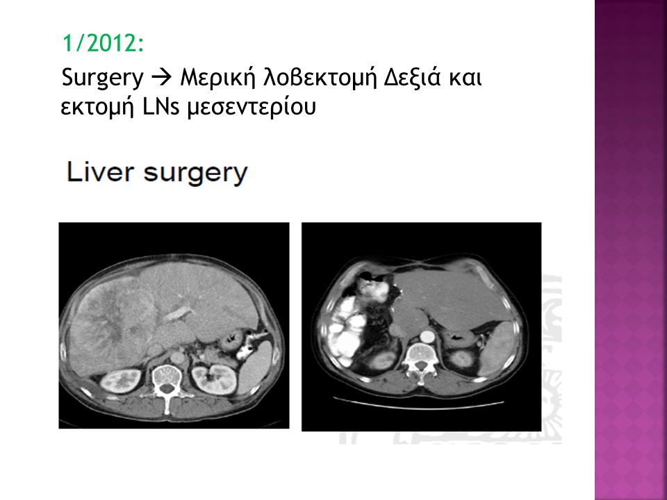 1/2012: Surgery  Μερική λοβεκτομή Δεξιά και εκτομή LNs μεσεντερίου