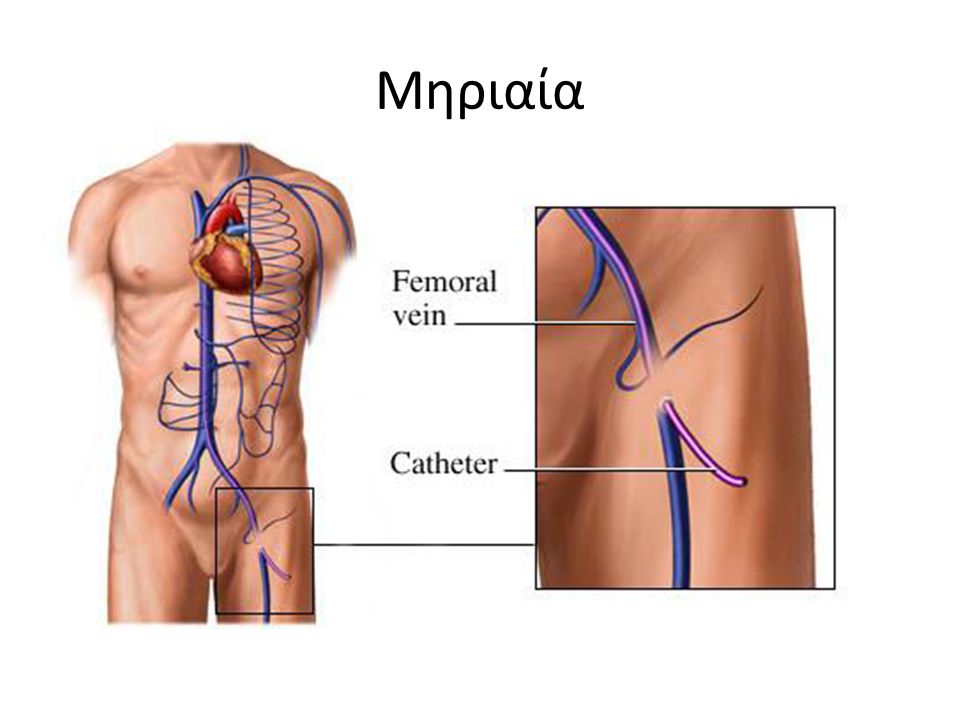Катетеризация бедренной. Бедренная Вена катетеризация ориентиры.