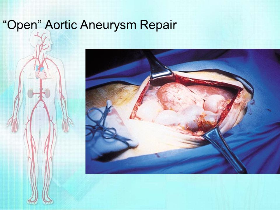 Open Aortic Aneurysm Repair